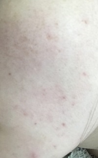 赤ニキビの治療中なのですが 大学１年 18 の男です 高 Yahoo 知恵袋