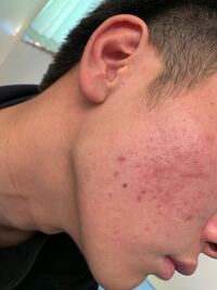これは色素沈着していますか また このニキビ跡はどのようなケアで治り Yahoo 知恵袋