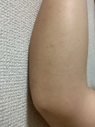 腕の 肘から下の部分が汚いです どうしたらプツプツや黒ずみが消えますか Yahoo 知恵袋