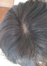 これはつむじハゲ もしくはハゲかけでしょうか それともただ髪が細くてつむ Yahoo 知恵袋