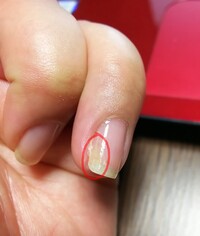 指の爪が剥がれてきました 取りあえず 短くして強化剤 エンビー Yahoo 知恵袋
