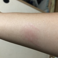 なんで火傷の痕って消えないの 何度かバイトで油が飛んだり鍋に Yahoo 知恵袋