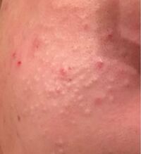 閲覧注意 男子高校生です 最近ほっぺの毛穴や白いプツプツ Yahoo 知恵袋