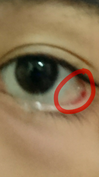 目の病気 についての質問です目の裏に白い粘膜 みたいな物があったんですがこ Yahoo 知恵袋