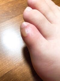 靴擦れのせいで小指が少し腫れ 水膨れが出来てしまいました とても痛いです Yahoo 知恵袋