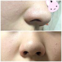 毎日鼻の毛穴から出てくる皮脂について石鹸や洗顔料はもちろん水やぬるま湯 Yahoo 知恵袋