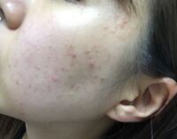 肌荒れがすごいです 頬 フェイスラインにかけてこのような感 Yahoo 知恵袋