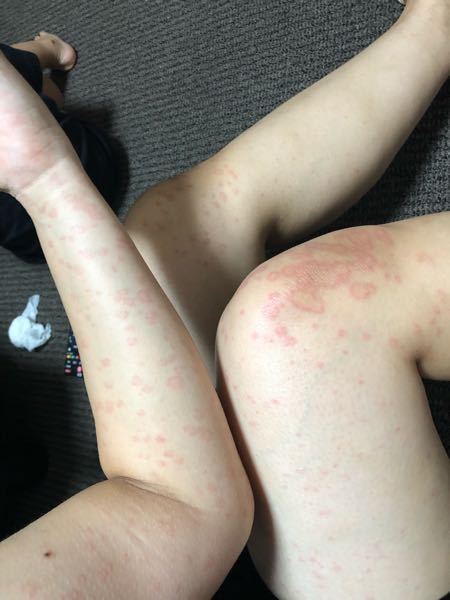 一昨日腕に発疹ができ、 - 昨日皮膚科で薬疹と診断されました。全 
