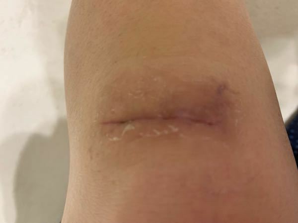 膝を10針ほど縫う怪我をしました かなりの出血がありました 10日後 Yahoo 知恵袋