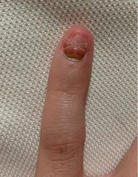 1ヶ月前ぐらいに、ネイルでスカルプをしていたのですが、左の小指が