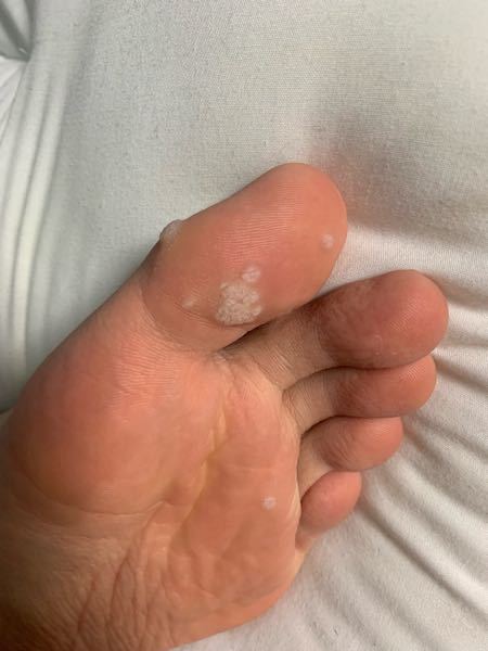 足の魚の目が5日でポロリと剥けるband Aidで大満足