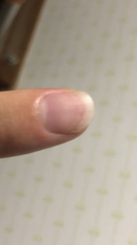 人差し指に黒い縦線が2本小さくできたのですがメラノーマなんですか 最近貧血 Yahoo 知恵袋