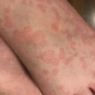 観覧注意です 3日程前に病院で溶連菌と診断されましたが喉も Yahoo 知恵袋