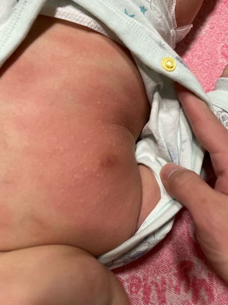 生後5ヶ月になる赤ちゃんです 皮膚に関して毎月病院で保湿の Yahoo 知恵袋