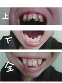 今度キレイラインで歯列矯正を検討しています 今年で21歳になります 小学生 Yahoo 知恵袋