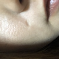 ほくろ除去の傷跡について 3年ほど前に切開してホクロを除去しまし Yahoo 知恵袋