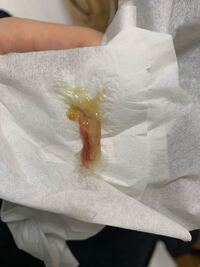 閲覧注意汚いない内容で申し訳ないのですが昨日の朝から喉が痛みだし昨日の夜頃 Yahoo 知恵袋