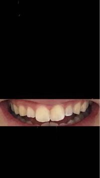 高校生です この歯をどうにかして治したいです顎を開くと音が鳴 Yahoo 知恵袋