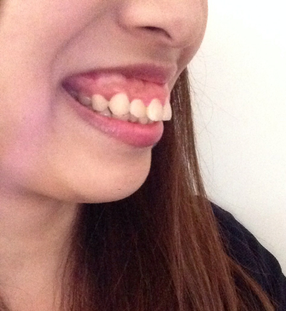 0以上 ひどい ガミースマイル 可愛い