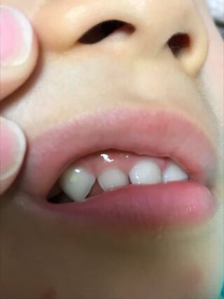 虫歯 麦茶