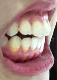 お見苦しい写真失礼します 元々受け口で矯正をしていたのです Yahoo 知恵袋