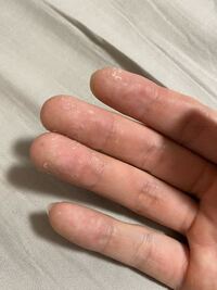 これは水虫ですか 痒いですか 手荒れなのですが 私が同じような症状で Yahoo 知恵袋