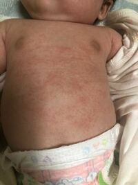 生後2ヶ月の赤ちゃんの肌荒れについて 体に赤い湿疹のようなものが出来 Yahoo 知恵袋