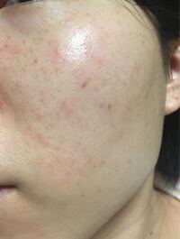 ニキビができる食べ物top3を教えてください 美容 食事 Yahoo 知恵袋