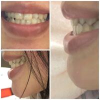 この歯どうおもいますか ビーバー歯ですコンプレックスで矯正を考えてた Yahoo 知恵袋