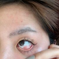 先日 コンタクトを取る際爪で眼球の白い部分を 傷付けてしまったのですが Yahoo 知恵袋