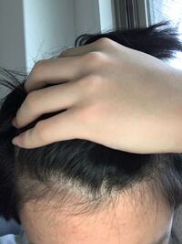 これm字ハゲの前兆でしょうか 高校生です Yahoo 知恵袋