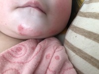 赤ちゃんの湿疹についてです よだれかミルクかぶれだと思うのですが 顎下に湿 Yahoo 知恵袋