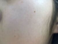 兄に殴られて顔面打撲 痣 腫れ 内出血 しました 明日警察に Yahoo 知恵袋