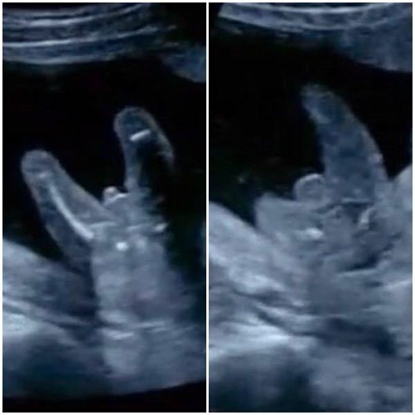 妊娠18週ぴったりのエコー写真です 性別はどちらでしょうか Yahoo 知恵袋
