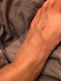 4ヶ月ほど前にリスフラン関節を痛めました スケボーをしていた際に 母 Yahoo 知恵袋