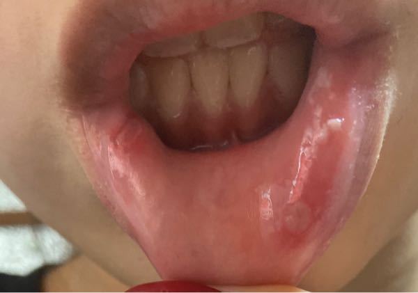 口内炎が2週間くらい治らなく 右の下唇付近に白い皮みたいのが ここ数日 Yahoo 知恵袋