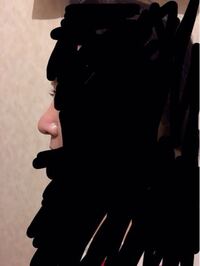 鼻の整形について 半年前に湘南美容外科で鼻の整形 鼻翼縮小以外 を受け Yahoo 知恵袋