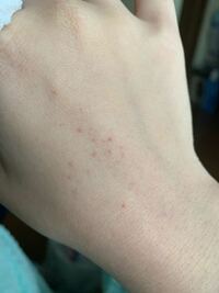 赤い斑点 手 皮膚の赤い斑点は病気？かゆみがあるなしでの７つの原因と対処法！