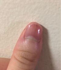 爪の黒い線は何か病気の兆候でしょうか 自分で調べてみたのですが ガン Yahoo 知恵袋