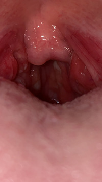 喉に白い膿のようなものがあります 咽頭淋病かなにかですか 3日前にそういう Yahoo 知恵袋