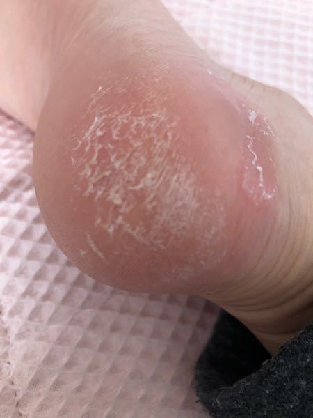 これは かかと水虫でしょうか 一部だけガサガサしており か Yahoo 知恵袋