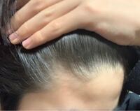 M字はげなりかけてますかね 中学生です Yahoo 知恵袋