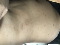 皮膚カビについてです 最初に汚い画像を乗せてしまい申し訳ございま Yahoo 知恵袋