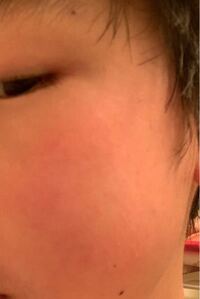 この頬の赤みをとりたいです 中学生男子で ほとんど一年中赤いです Yahoo 知恵袋