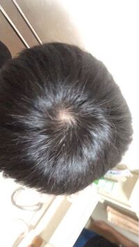 これはつむじハゲですか 光の下で撮りました 髪の毛は長くはありま Yahoo 知恵袋