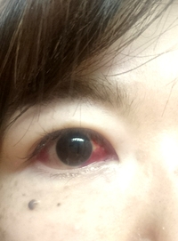 結膜下出血が3日続き今日急に広がりました 眼球の半分が真っ赤です 過去にも Yahoo 知恵袋