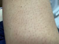 腕のブツブツについて 男 高校生です 二の腕にぶつぶつができています Yahoo 知恵袋
