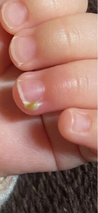 生後4ヶ月のあかちゃんの爪の横に こんなのができてました これはな Yahoo 知恵袋