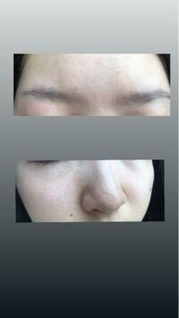 閲覧注意 鼻の毛穴の黒ずみがなくなる方法はありませんか 毛穴に効く Yahoo 知恵袋