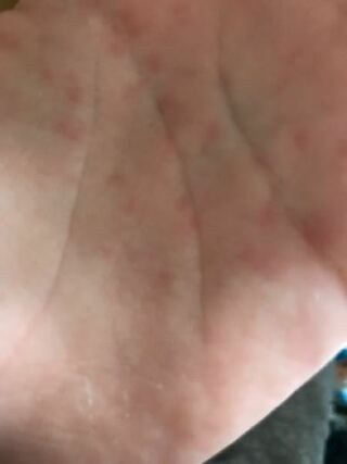 手のひらに赤い斑点があるのにきずきました これは何かの病気 Yahoo 知恵袋